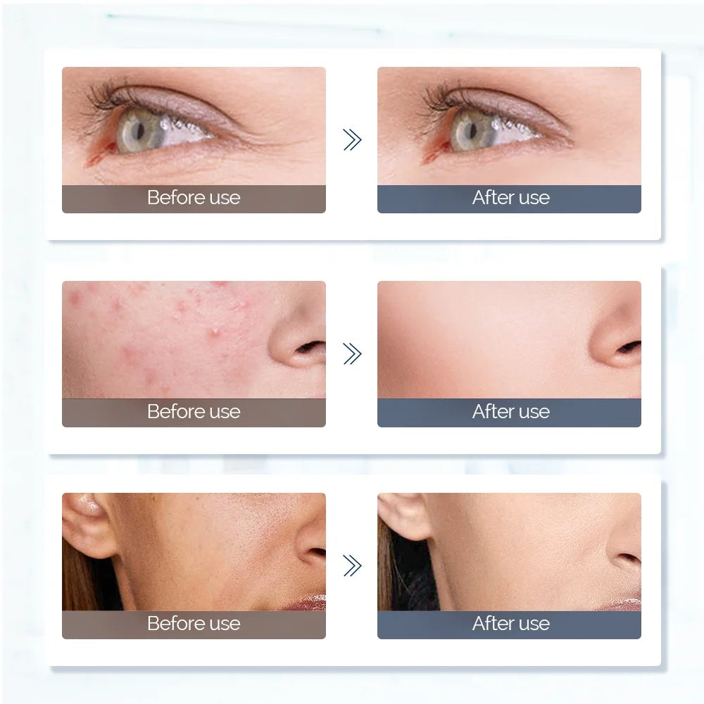 LED Light Therapy Mask for Face & Neck