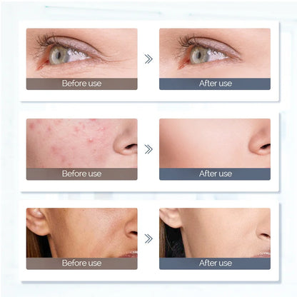 LED Light Therapy Mask for Face & Neck