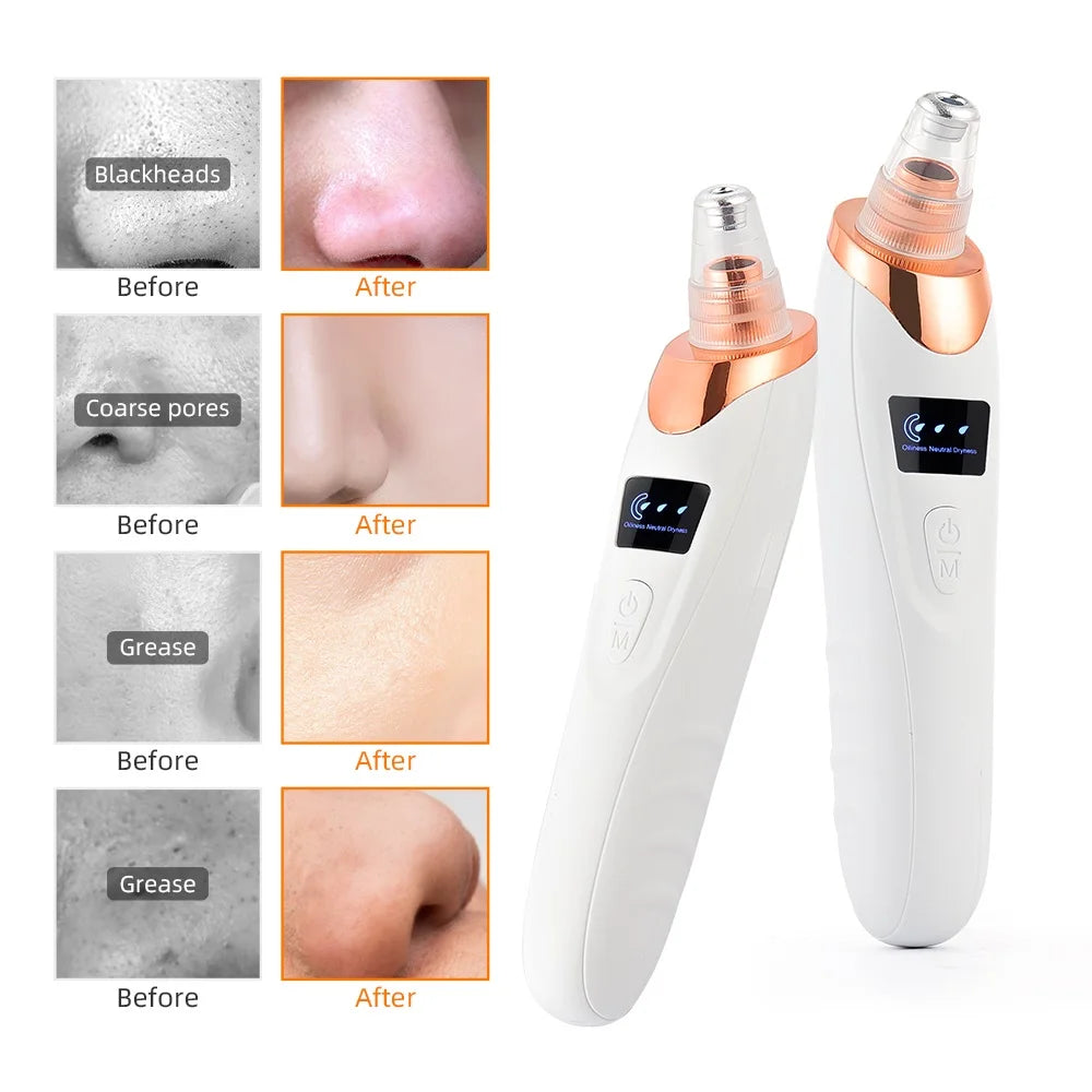 Vacuum Blackhead Remover – Deep Pore Cleansing & Skin Care
