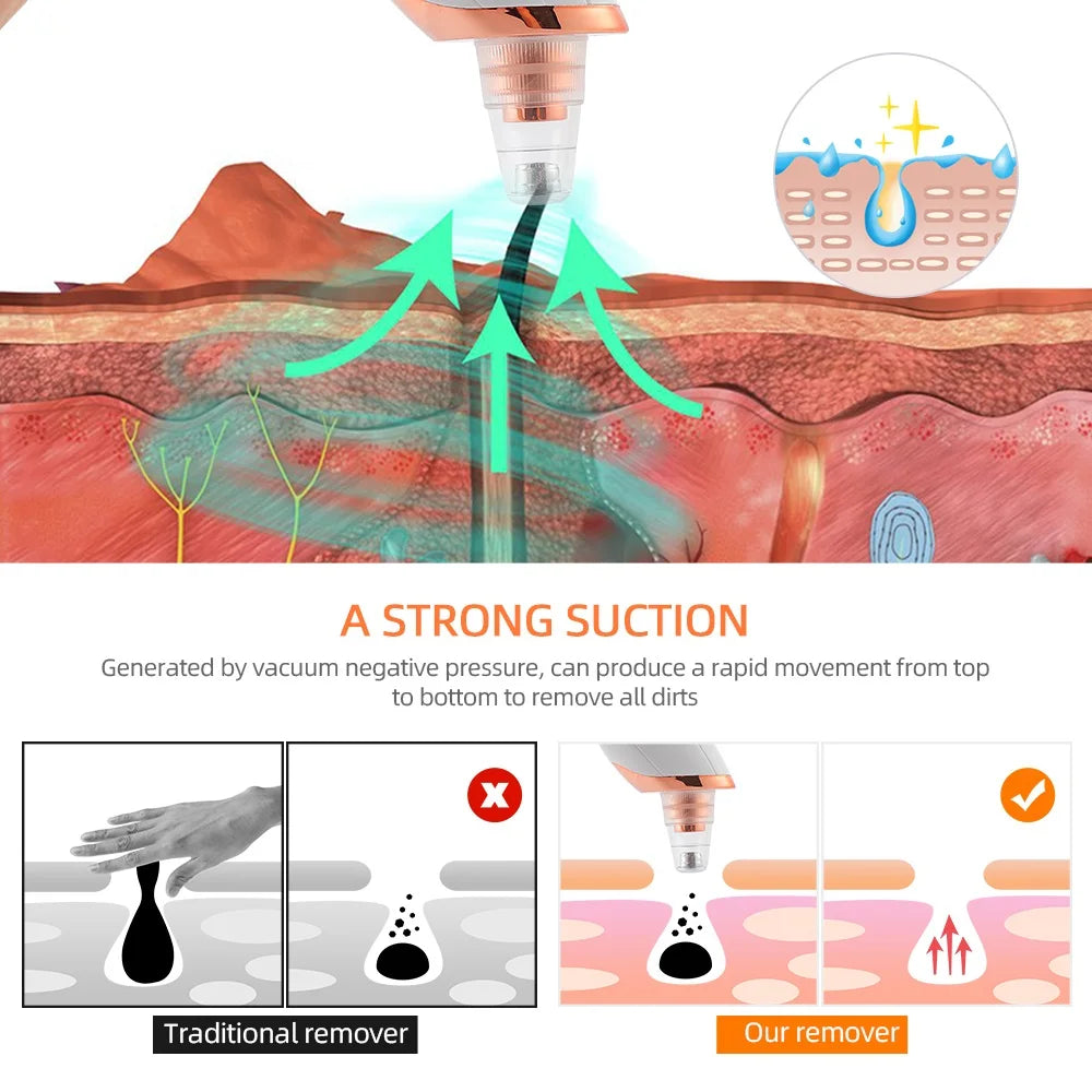 Vacuum Blackhead Remover – Deep Pore Cleansing & Skin Care